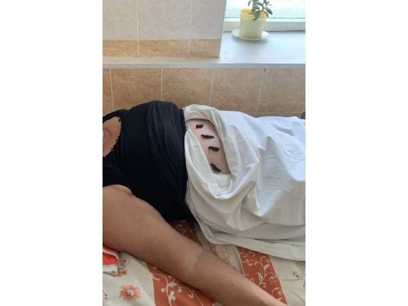 Применение пиявок при артериальной гипертензии